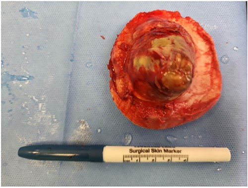 Intraoperative photo of the lesion while still attached to the bone and after the feeding vessel has been cauterized.