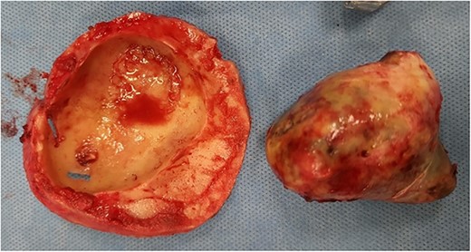 Intraoperative photo of the lesion after the lesion has been dissected off the bone. Note evidence of the bone remodelling as well as erosion of the bone.