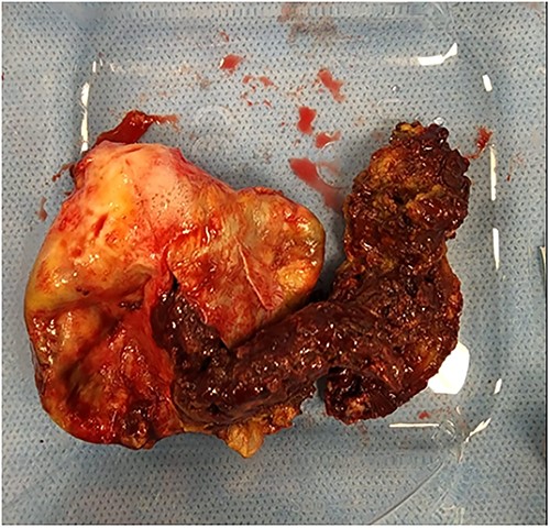 The lesion was cut open with the scalp and intralesional haemorrhagic products.