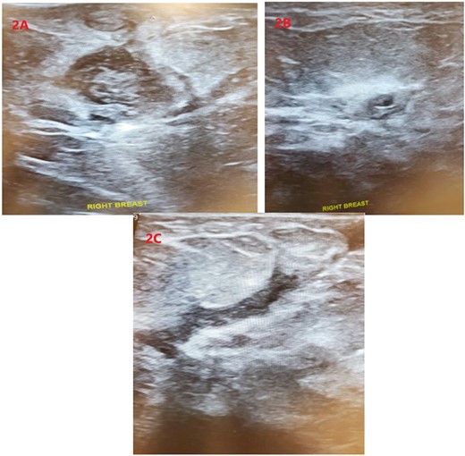Sonographic imaging of the right breast identifying two complex fluid collections (A) and (B) at the 3:00 position. (C) Showing a fistula tract.