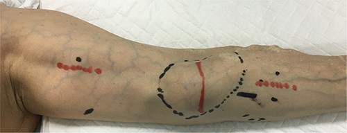 The initial physical examination showed a hard mass (black circle) at the left antecubital fossa of the volar aspect. Red lines indicate planned incision lines for surgery.