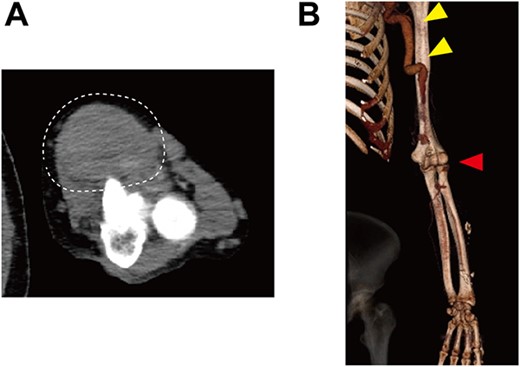 Preoperative contrast CT showing (A) a true brachial aneurysm at the anterior aspect of the elbow joint, which was obstructed by a thrombus (white dashed circle), and (B) the dilated brachial artery (yellow arrows). Red arrow indicates the level of the true brachial aneurysm.