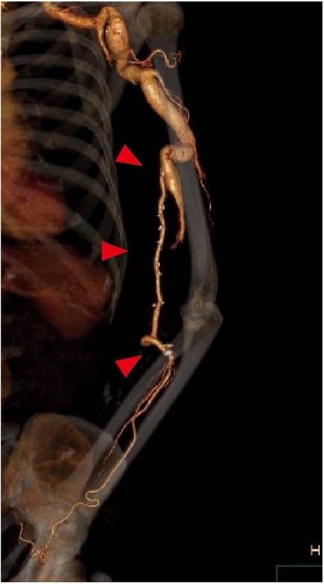 Postoperative contrast CT showing the patent great saphenous vein graft (red arrows) anastomosed from the brachial to ulnar artery. To prevent graft occlusion due to elbow flexion, the graft was routed through the ulnar side of the elbow.