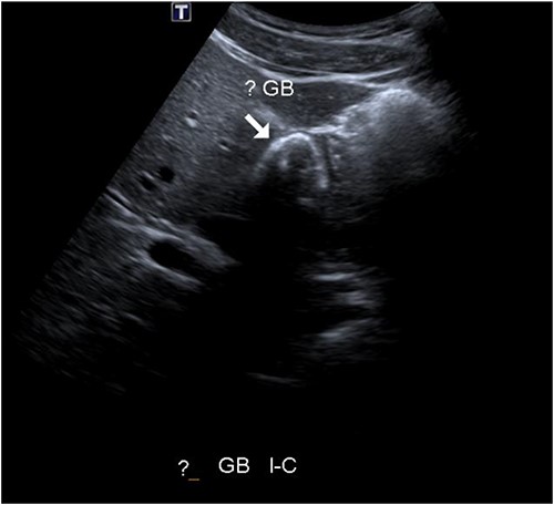 Abdominal ultrasound showing potential contracted gallbladder.