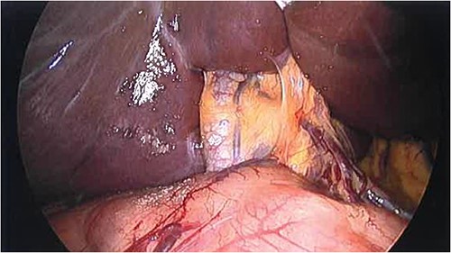 Intraoperative finding of the absence of gallbladder and cystic duct—common bile duct noted entering the liver.