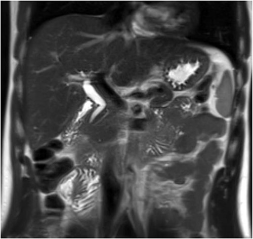 Post-operative MRCP confirming congenital gallbladder agenesis.