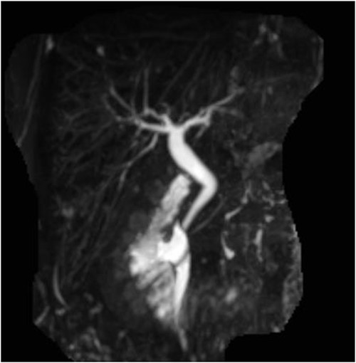 Post-operative MRCP confirming congenital gallbladder agenesis.