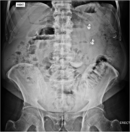 Abdominal X-ray identifying two hearing aids on day of initial presentation.