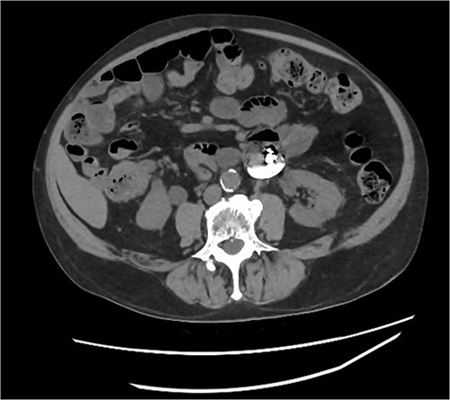 Abdominal CT identifying one hearing aid in a jejunal diverticulum 3 weeks after initial presentation – axial view.