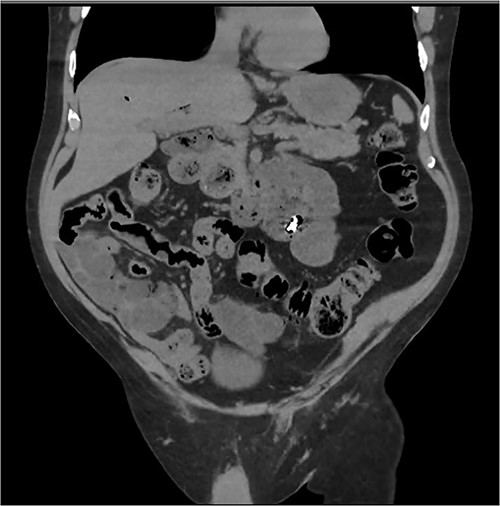 Abdominal CT identifying one hearing aid in a jejunal diverticulum 3 weeks after initial presentation – coronal view.