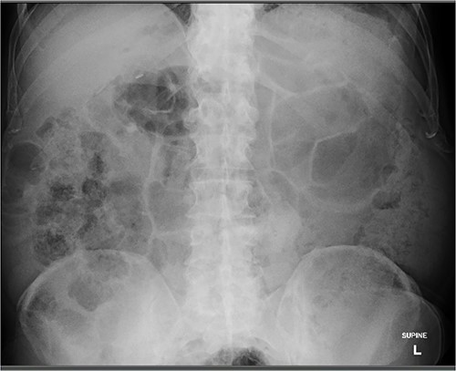 Abdominal X-ray demonstrating passage of second hearing aid.