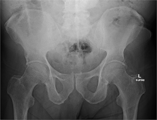 Pelvic X-ray demonstrating passage of second hearing aid.