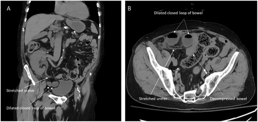 CT images showing herniated ileal loops under the transplanted ureter. (A) Coronal view. (B) Axial view.