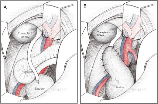 Diagrammatic representation of (A) Herniation of small bowel behind the ‘criminal band’ transplanted ureter, and (B) the modified psoas hitch of the anterior bladder wall to obliterate the sub-ureteric space.