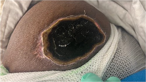 Left gluteal region showing necrotic patch 4 weeks following Intramuscular Diclofenac Injection.