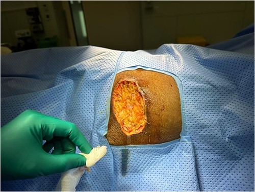 Intraoperative image of left gluteal region post-debridement of the soft tissue necrosis until reaching healthy tissue.