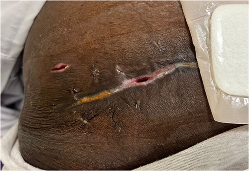 Post-operative image of the left gluteal region 3 weeks after debridement and closure of the wound.
