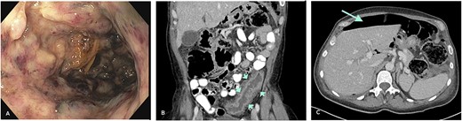 (A) Severe colitis with deep ulcerations on endoscopy. (B) Left-sided colonic wall thickening (CT-scan; short arrows). (C) Intraperitoneal air indicative of hollow viscus perforation (CT-scan; long arrow).
