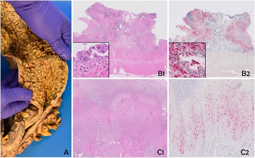 The specimen shows severe diffuse necrotizing colitis (A). Histology reveals extensive ulcerous colitis with deep-reaching ulcers and mural necrosis (B1 and C1). Multinucleated epithelial cells with eosinophilic inclusions can be discerned (insert B1). Immunohistochemistry for human HSV confirms a widespread infection of the mucosa and the mural part of the colonic wall (B2 and C2). Epithelial cells, as well as stromal cells, are positive (insert B2). B1 and C1: Hematoxylin and Eosin; C1 and C2: Immunohistochemistry for HSV (Chromogen: Fast Red).