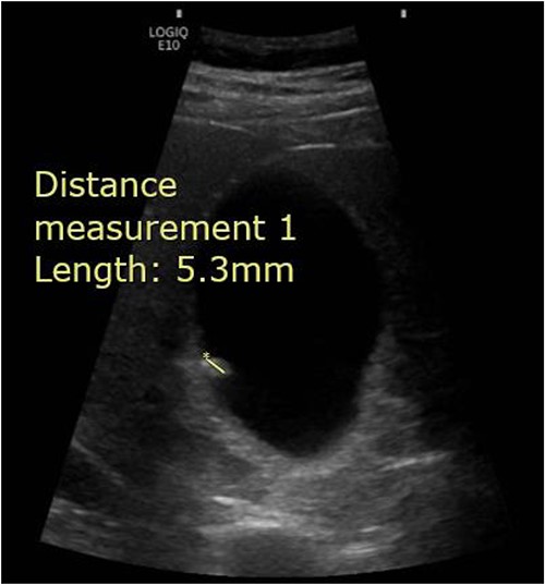 Abdominal ultrasound demonstrating the presence of a 5.3 mm stone within the gallbladder.