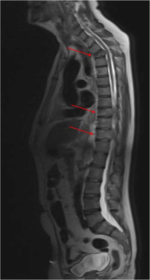 Sagittal MRI whole-spine demonstrating extensive bony metastatic disease. Malignant compromise to the spinal canal at T3, T9 and T11 (red arrows).