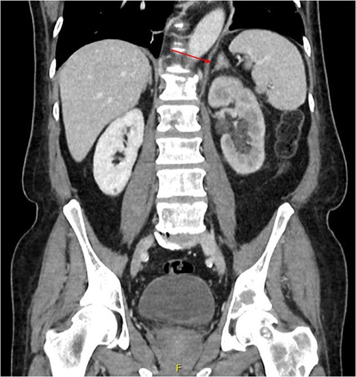 Coronal CT abdomen and pelvis scan with contrast demonstrating left-sided hydronephrosis and left-sided adrenal mass (red arrow).