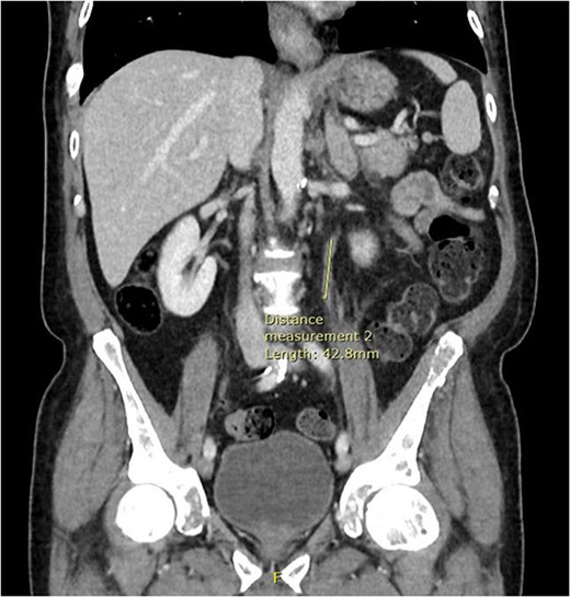 Coronal CT abdomen and pelvis scan with contrast demonstrating urethral enhancement for a distance of 42.8 mm.