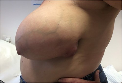 Left breast lump on first presentation.