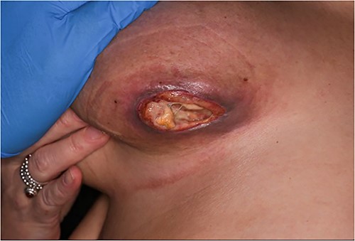 Left breast necrotic ulcer 1-week post-chemotherapy.