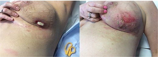 Outcome and healing of the breast wound.