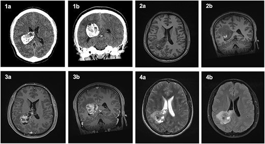 Computed Tomography and Magnetic Resonance Imaging showing a mass within the trigone of the right lateral ventricle. On CT, axial (1a) and coronal (1b) sections revealed a calcified mass with a central cystic component. Pre-contrast T1-weighted imaging showed an isointense mass with a central ring of enhancement on axial (2a) and coronal (2b) slices. Post-contrast T1-weighted imaging with irregular enhancement of the lesion on axial (3a) and coronal (3b) slices. Axial T2-weighted imaging (4a) and FLAIR (4b) exhibited an isointense lesion with surrounding oedema.
