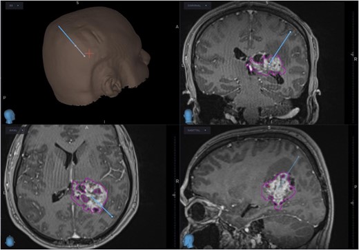 Planned trajectory for excision of the tumour, as seen on the neuronavigation system.