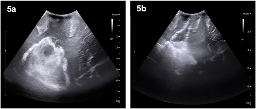 Preoperative (5a) ultrasound images depicting a heterogenous mass with hyperechoic and hypoechoic regions. Post-operatively (5b), a hyperechoic region is noted; however, no distinct lesion is identified.