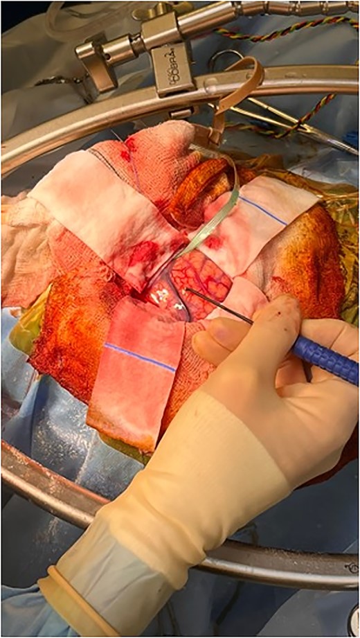 Intraoperative image depicting the use of MEPs to identify the precentral gyrus, prior to insertion of the VBAS. In this image, the anterior aspect of the head is to the right, whereas the posterior aspect is to the left.