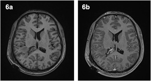 Post-operative magnetic resonance imaging revealed evidence of intraventricular enhancement, with no distinct lesion identified on axial T1-weighted imaging pre- (6a) and post-contrast (6b).