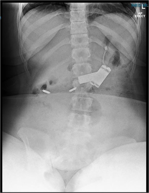 Abdominal X-ray demonstrating four battery-shaped foreign body at the level of L1/L2.