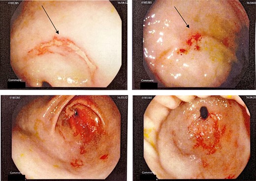 Gastroscopy showing extensive burns in antral and greater curvature of stomach.