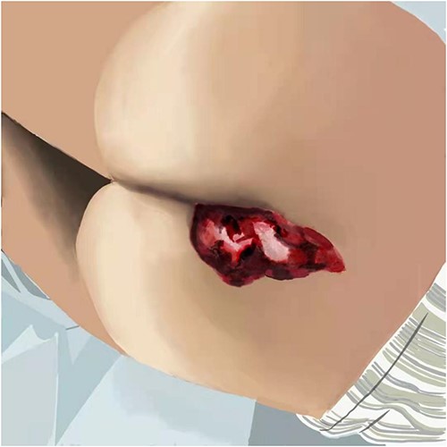 Depicts hydrogel application process.