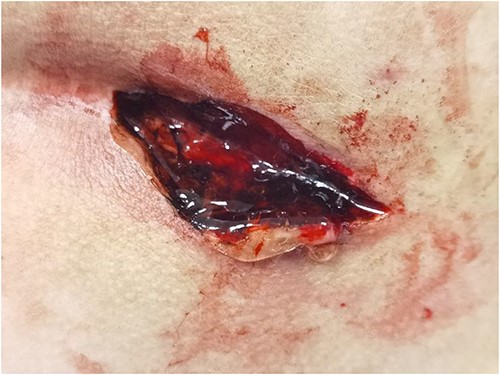 Depict the wound was sealed with hydrogel.