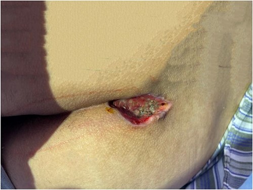 Depict wounds on discharge.