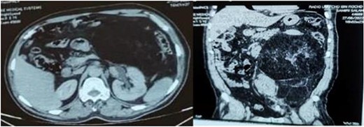 Axial and sagittal sections of an abdominal-pelvic CT scan showing a retroperitoneal liposarcoma compressing the surrounding structures and responsible for left pyelocaliceal dilation.