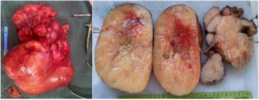 Macroscopic appearance of a voluminous dedifferentiated liposarcoma, respectively retro-peritoneal of 30 cm well encapsulated, firm with whitish areas, necrotic, slightly hemorrhagic and 20 cm hard testicle with unidentifiable spermatic cord lumen.