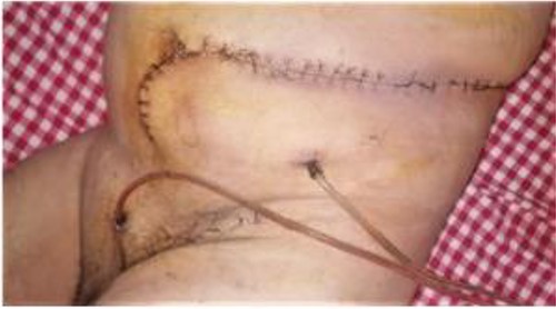Illustrative image of wound healing with redon drains in place on postoperative day 7.