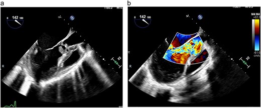 (a) TEE demonstrating large vegetation under aortic valve, (b) TEE demonstrating severe aortic regurgitation.