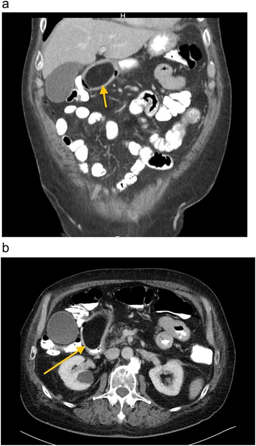 (a) and (b) CT-Abdomen, showing duodenal mass ⁓7.4 × 4.4 cm pressing the Pylorus.