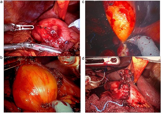 (a) After surgical preparation, the duodenum is exposed and prepared through Kocher maneuver for robotic-assisted duodenotomy. (b) The Lipoma is revealed after the duodenotomy is completed. (c) The Lipoma is then transduodenally resected. (d) The duodenotomy is then repaired in two layers, transversely.