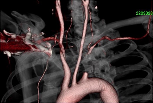 Chest ECT showed total and long occlusive lesion of the left subclavian artery. ECT, enhanced computed tomography.