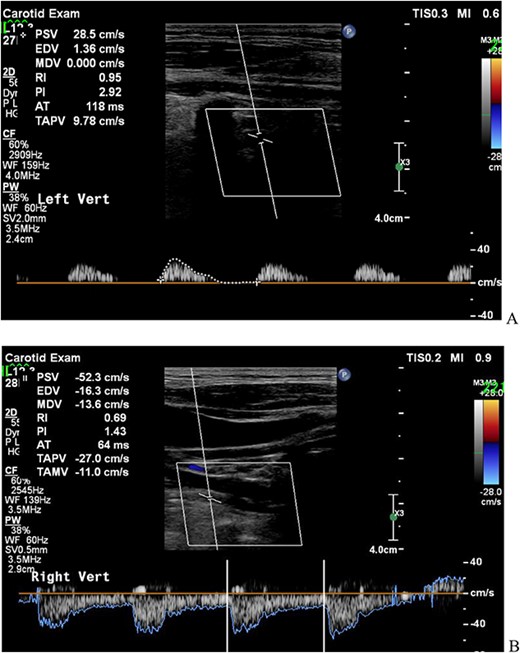CDUS showed the retrograde blood flow of the left VA before operation (A; left VA, B; right VA). CDUS, carotid Doppler ultrasonic echography; VA, vertebral artery.