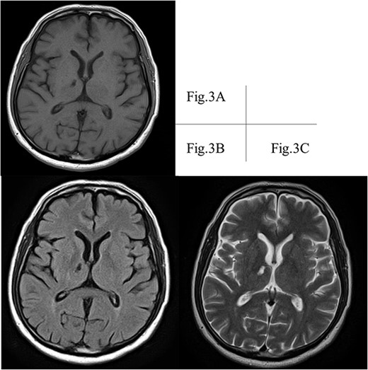 A right thalamic lacunar infarction is detected hypointense on T1-weighted image. (A) and FLAIR image (B), and hyperintense on T2-weighted image (C). FLAIR, fluid-attenuated inversion recovery; MRI, magnetic resonance imaging.