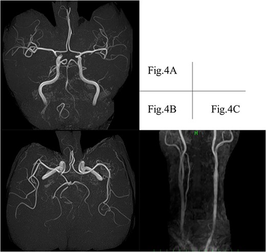 MRI depicts hypoplasia of the right VA without connection to the basilar artery. (A) Left posterior communicating artery (B) and suspected retrograde flow of the left VA (C). MRI, magnetic resonance imaging; VA, vertebral artery.